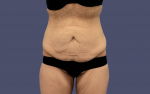 Abdominoplasty (Tummy Tuck) 21 Before